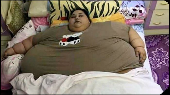 Punya Bobot 500 Kg, Perempuan Ini Sulit Bergerak
