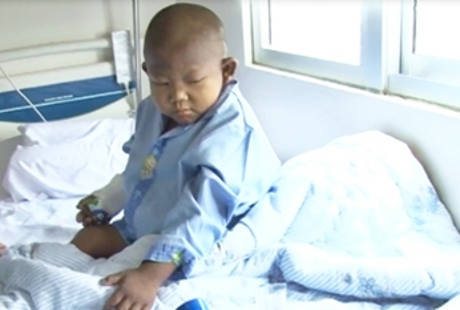 Mengenal Allegile Syndrome Sindrom Langka Yang Diderita Hafidz