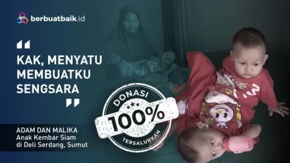 Adam dan Malika, Kembar Siam Berbagi Kaki yang Bergantung pada Ayah Kuli Serabutan