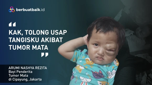Derita dan Tangis Anak Penjual Bihun Gulung Pengidap Tumor Mata