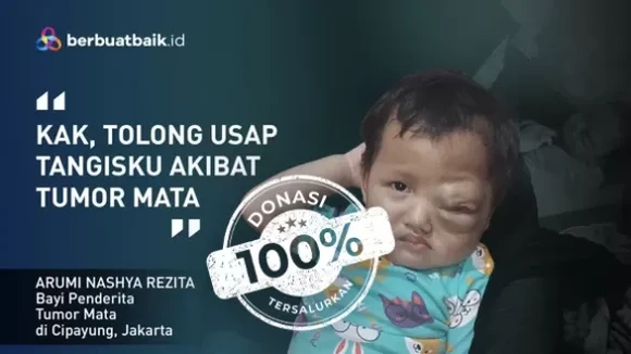 Derita dan Tangis Anak Penjual Bihun Gulung Pengidap Tumor Mata