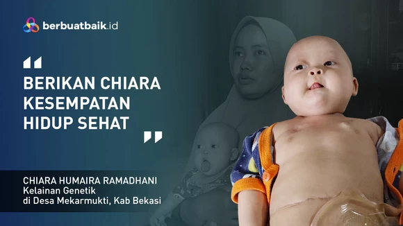 Dikepung Tumor Teratoma Immature, Balita Chiara Ingin Sembuh dan Sehat