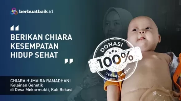 Dikepung Tumor Teratoma Immature, Balita Chiara Ingin Sembuh dan Sehat