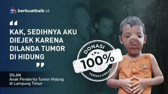 Dilanda Tumor Hidung, Nasib Miris Dilan Ditinggal Ibu dan Diejek Teman