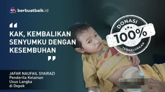 Jafar, Anak Sopir yang Derita Kelainan Usus Langka hingga Tak Bisa BAB Normal