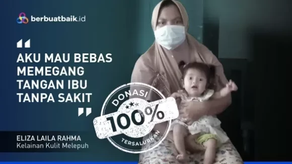 Kelainan Langka, Kulit Bayi Eliza Melepuh Kena Gesekan & Panas