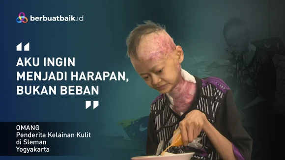 Kisah Pilu Omang Penderita Kelainan Kulit, Kurus Kering hingga Hilang Gigi dan Kuku