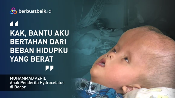 Kisah Sedih Anak Pekerja Serabutan, Alami Hidrosefalus dengan Tubuh Tak Berdaya