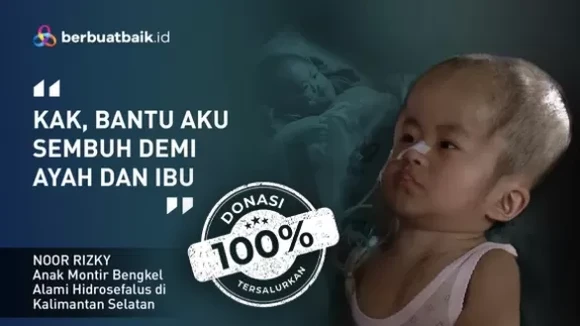 Perjuangan Keluarga Tukang Bengkel Jemput Kesembuhan Anak Hidrosefalus