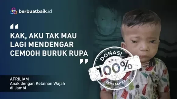 Sedihnya Nasib Afriliam, Bocah 2 Tahun Butuh Operasi Rekonstruksi Wajah