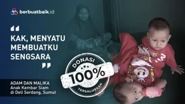 Adam dan Malika, Kembar Siam Berbagi Kaki yang Bergantung pada Ayah Kuli Serabutan