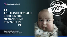 Derita Balita Rakha, Pipi Membesar karena Penyumbatan Pembuluh Getah Bening