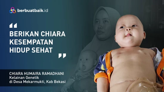 Dikepung Tumor Teratoma Immature, Balita Chiara Ingin Sembuh dan Sehat