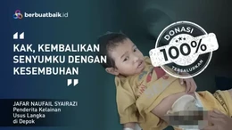 Jafar, Anak Sopir yang Derita Kelainan Usus Langka hingga Tak Bisa BAB Normal