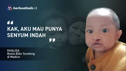Khalisa Balita Sumbing Ingin Tersenyum Lebih Indah Seperti Anak Lainnya