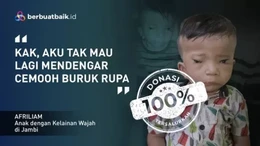 Sedihnya Nasib Afriliam, Bocah 2 Tahun Butuh Operasi Rekonstruksi Wajah