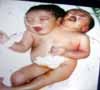 Hanya Punya 1 Jantung, Bayi Berkepala 2 Mustahil Dipisahkan