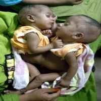 Seorang Bayi Kembar Siam Meninggal Usai Operasi Pemisahan