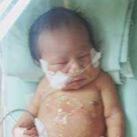 Kondisi Bayi Berkaki 4 di RSCM Stabil