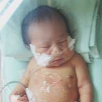 Bayi Berkaki 4 Akan Diberi ASI Lewat Mulut