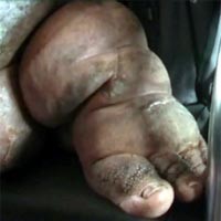 Penderita Kaki Gajah Gagal Dioperasi di RSU Soetomo