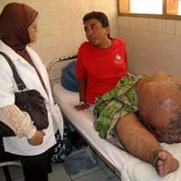 Penderita Kaki Gajah Berharap Jadi Pria Normal