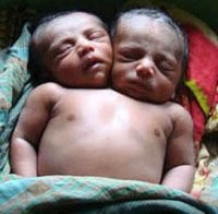 Kiron, Bayi Berkepala Dua