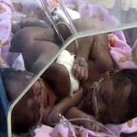 Kembar Siam Lahir di Nganjuk, Ibu Bayi Meninggal