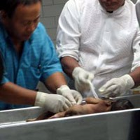 30% Kasus Kembar Siam RS Soetomo Berasal dari Kediri