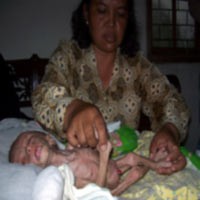 Usai Operasi Usus Terburai, Tubuh Arya Makin Kurus