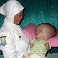 Bayi Hydrocepallus Tergolek Lemah Setahun di RS Madiun