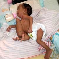 Kembar Siam NTT akan Dioperasi 10 November