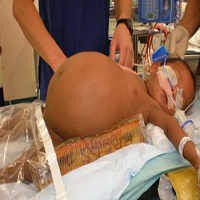 Tumor Seberat 3,3 Kg Berhasil Diangkat dari Tubuh Bayi