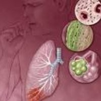 Diare dan ISPA Mulai Serang Warga Bandung