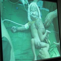 Hari Ini, Bayi Kembar Siam NTT Jalani Operasi Pemisahan