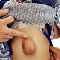 Jantung Bocah Tumbuh di Permukaan Kulit, Detaknya Bisa Terlihat