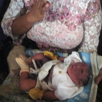 Siti Lahirkan Bayi Tanpa Tempurung Kepala di Bidan Desa