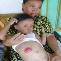 Sumbangan Bagi Windi Bocah Tanpa Anus Diperpanjang