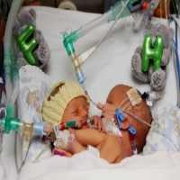 Bayi Kembar Siam Meninggal Setelah Dioperasi