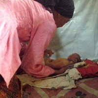 Bayi Tanpa Tempurung Kepala Akhirnya Meninggal