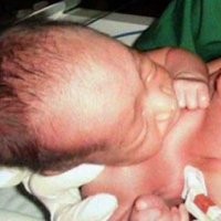 Bayi Kembar Siam Medan Miliki Kelainan Jantung
