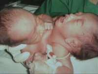 Lagi, Kembar Siam Masuk RSUP Adam Malik 