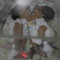 Bayi Kembar Siam Samarinda Dirujuk ke Surabaya