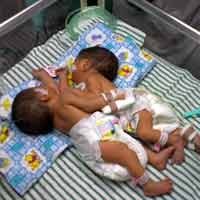 Kembar Siam Samarinda Jalani Echo Cardiography Hari Ini