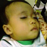 Jangan Anggap Sepele Benjolan di Pangkal Paha