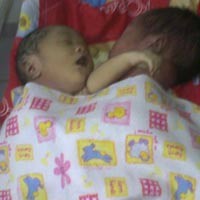 Orangtua Kembar Siam Ambon Shock