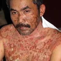 Pengobatan Penyakit Misterius Sugiono akan Dibantu Dinkes