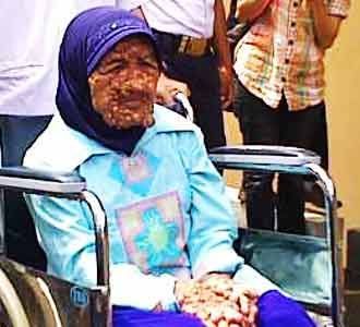 Yani Penderita Tumor Diizinkan Pulang