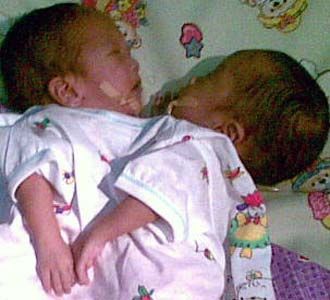 Kembar Siam Gagal Dioperasi