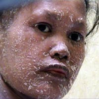 Setelah Melahirkan, Kulit Pestaria Bersisik